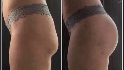 BBL in Turkije: Kan dat mislukken?