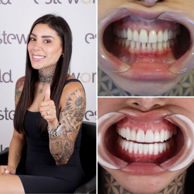 Veel gestelde vragen over tandartsbehandelingen in Turkije