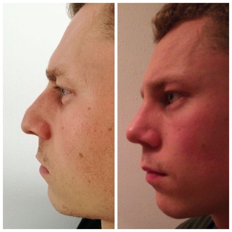 Stef neuscorrectie Turkije