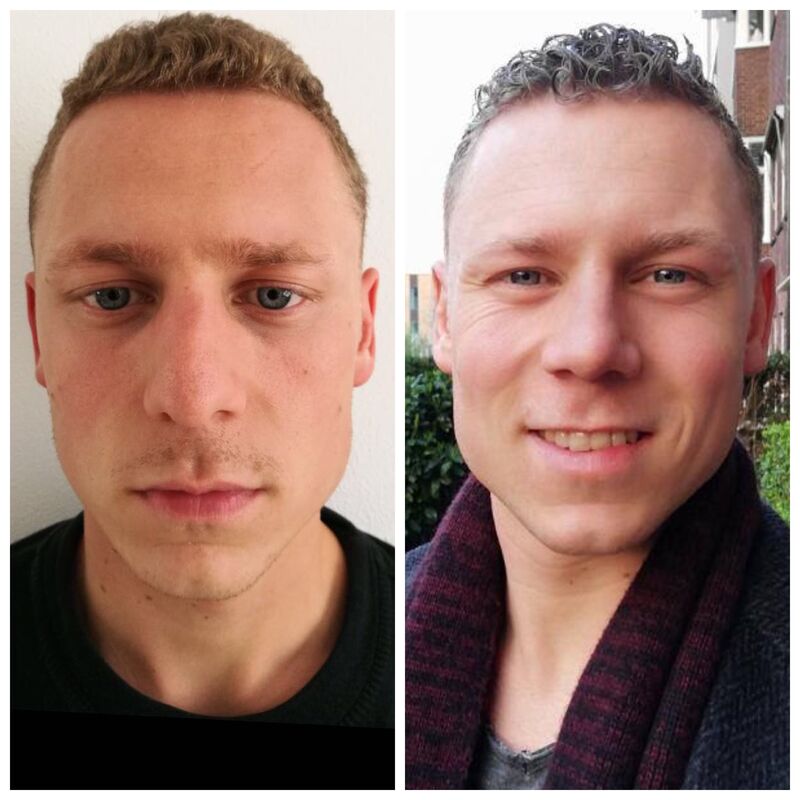 Stef neuscorrectie Turkije