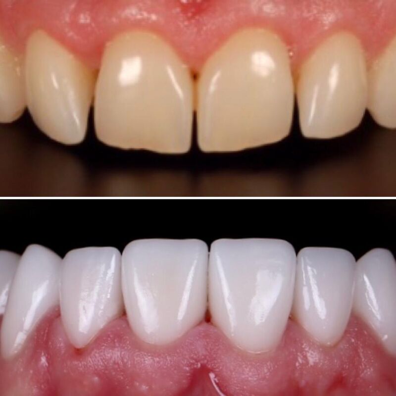 Nieuw gebit voor Gordon in Turkije