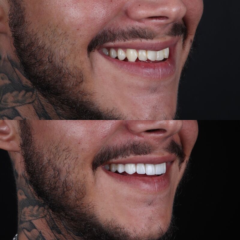 2 broers voor Glamoursmile bij Esteworld