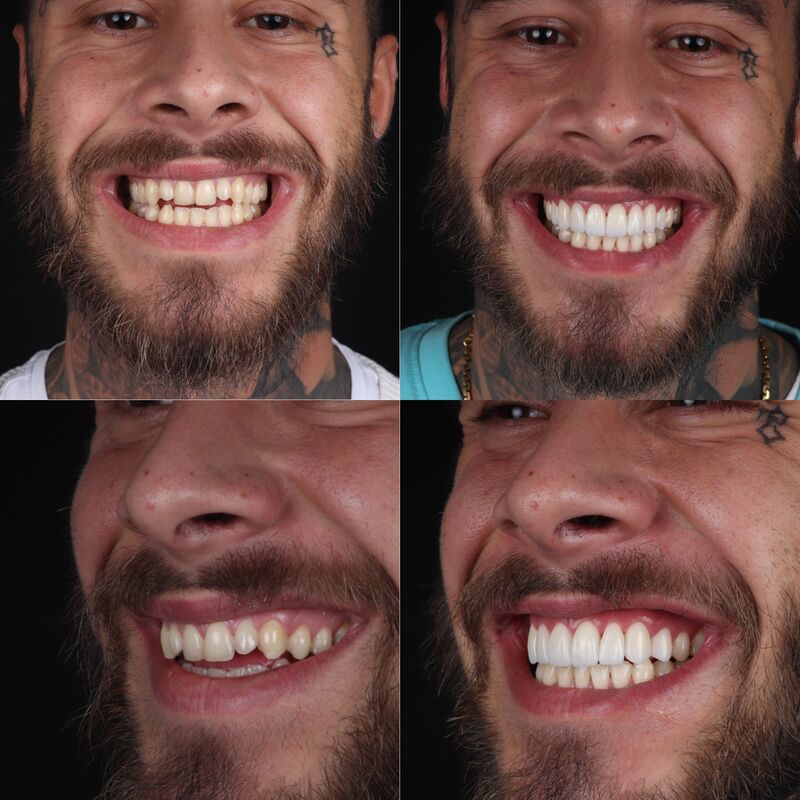 2 broers voor Glamoursmile bij Esteworld