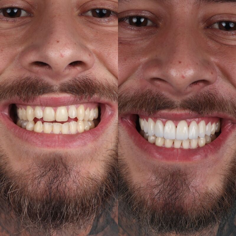 2 broers voor Glamoursmile bij Esteworld