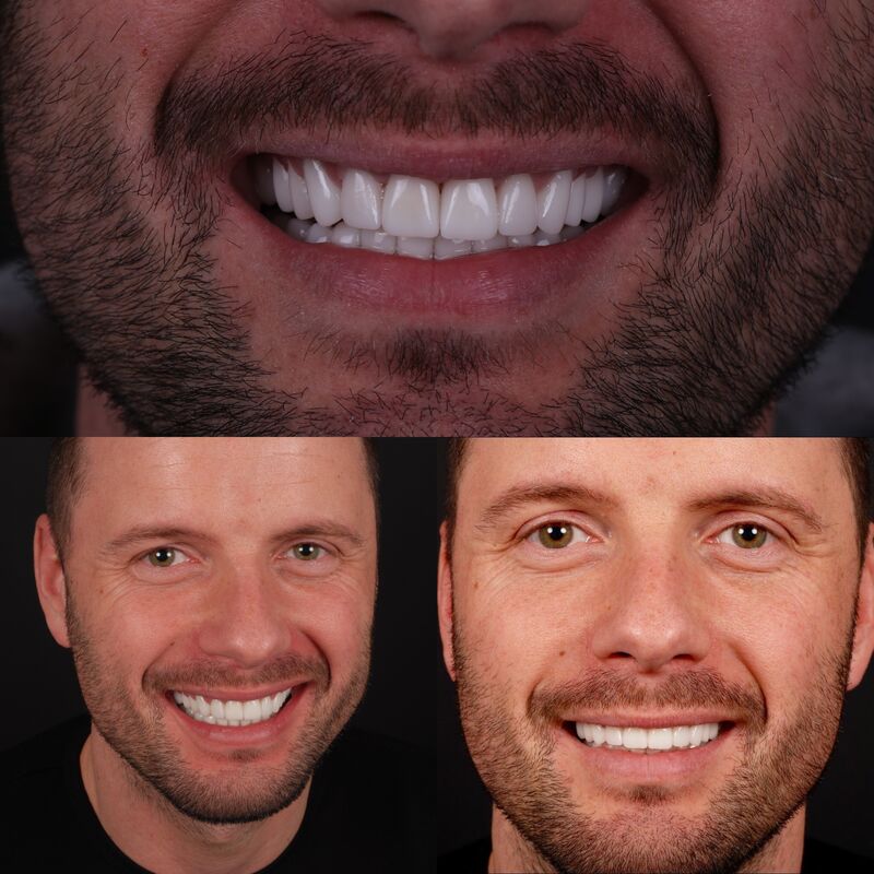 Nieuw gebit voor Gordon in Turkije