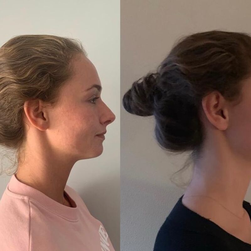 Marielle, voor een neuscorrectie moet je bij Esteworld zijn.