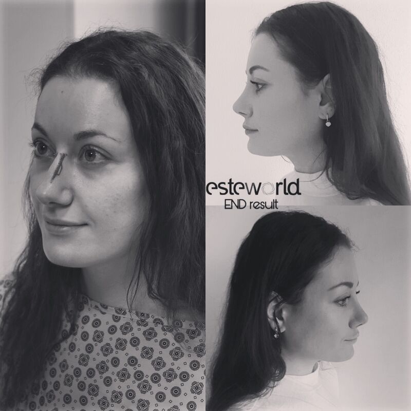 2 zusjes neuscorrectie bij Esteworld