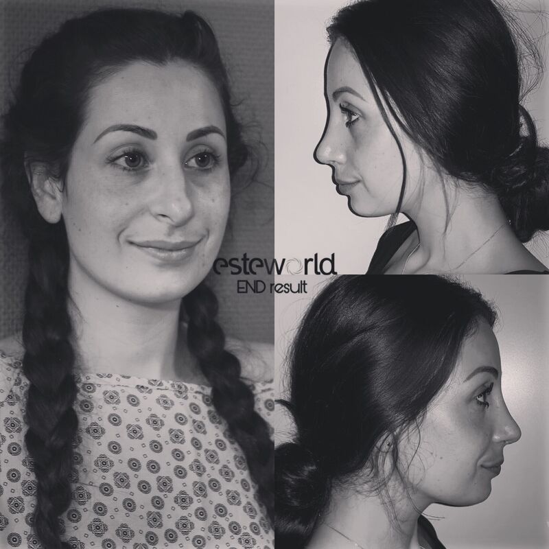 2 zusjes neuscorrectie bij Esteworld