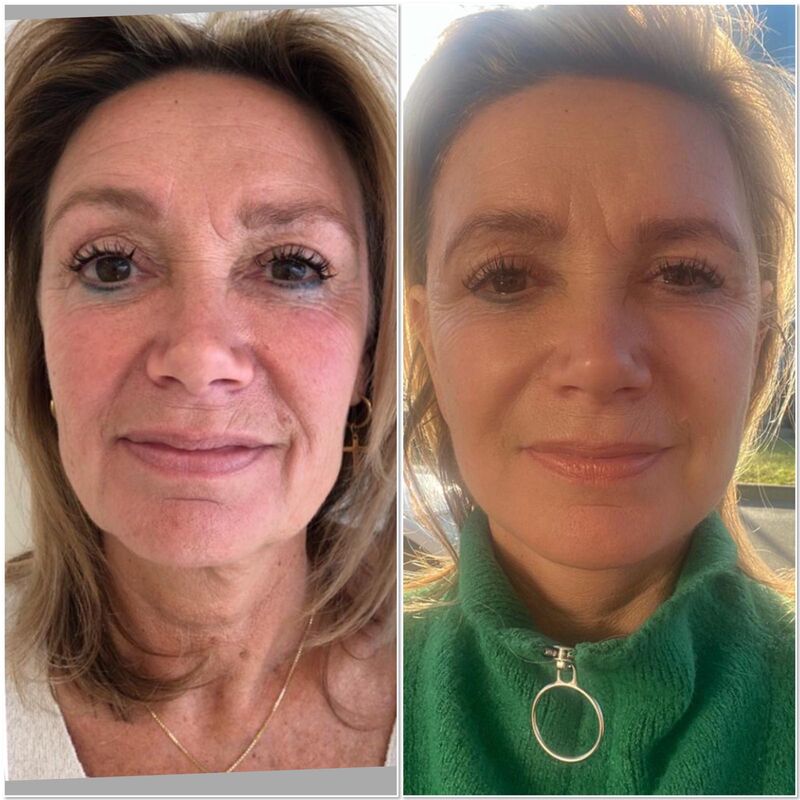 Corina facelift bij Esteworld