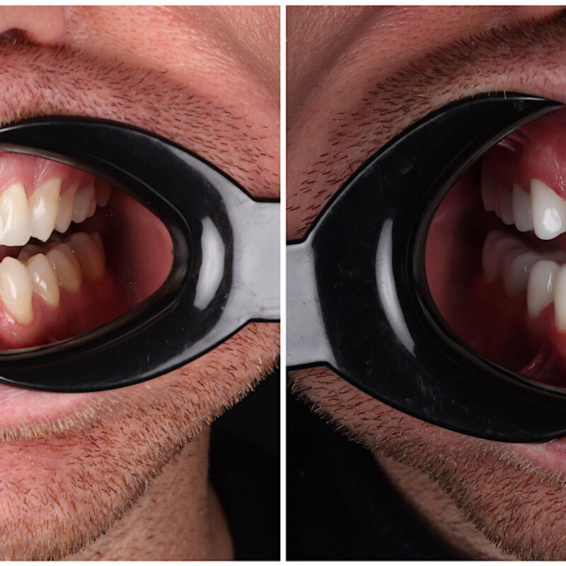 Via 3 vrienden bij Esteworld voor facings en kronen