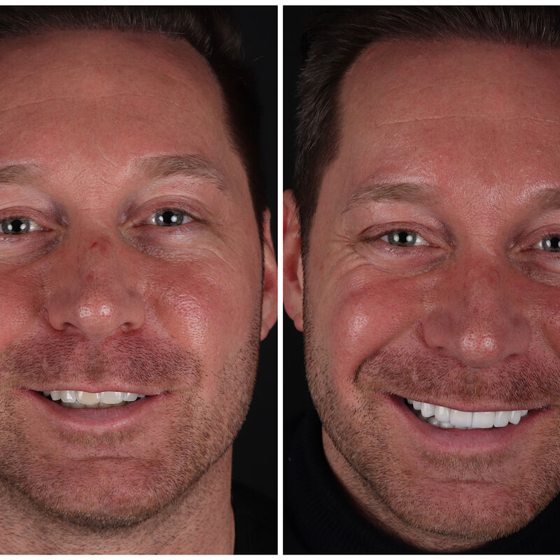 Via 3 vrienden bij Esteworld voor facings en kronen