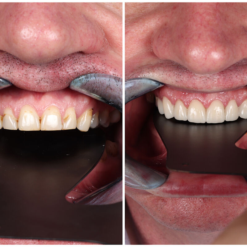 EMAX kronen en Facings Turkije, neusje van de zalm.