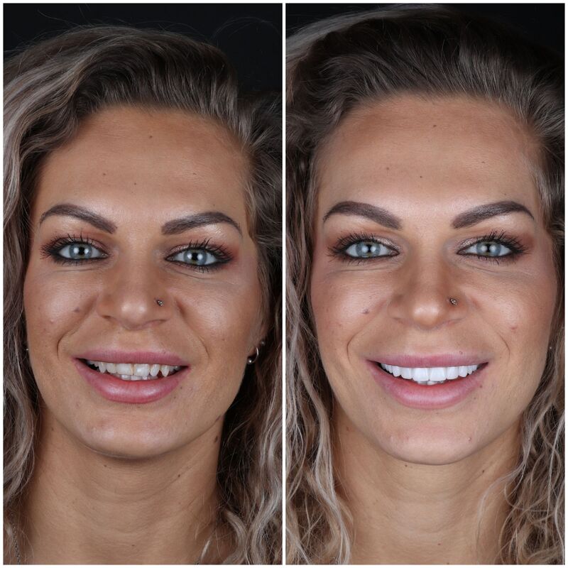 @EvelienNellen voor kronen en facings naar Turkije