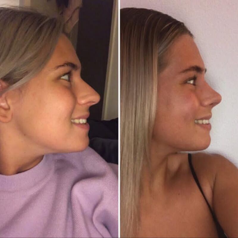 Beste keuze ooit geweest! Blij met mijn Neus!