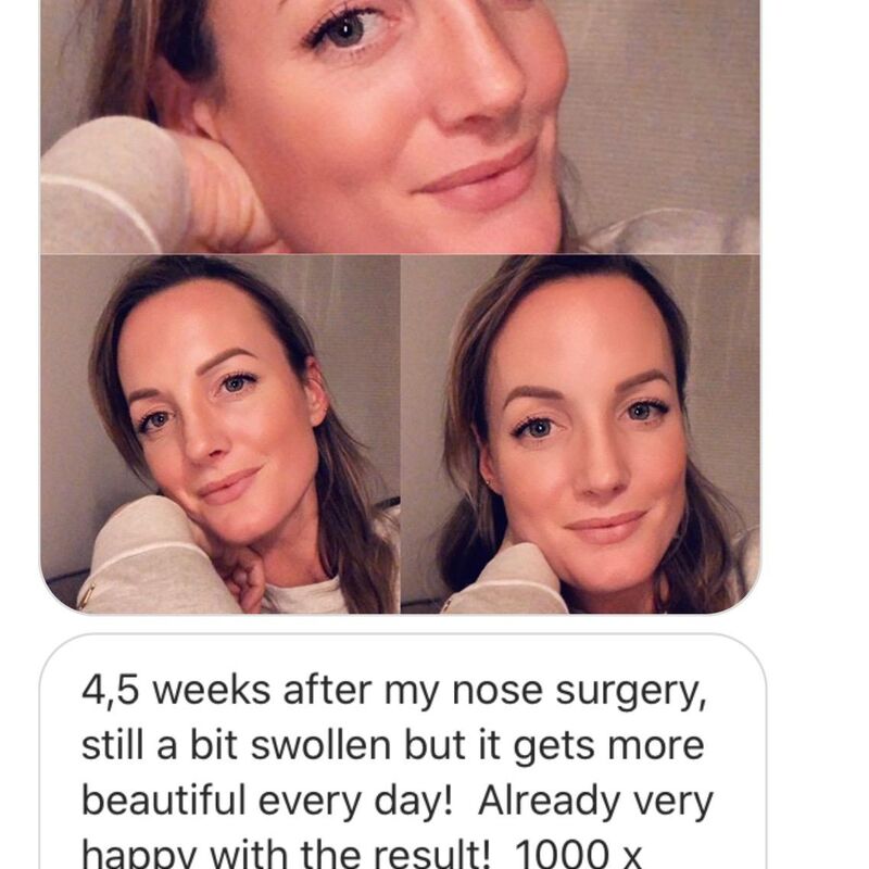 Esteworld bedankt voor mijn nieuwe neus!