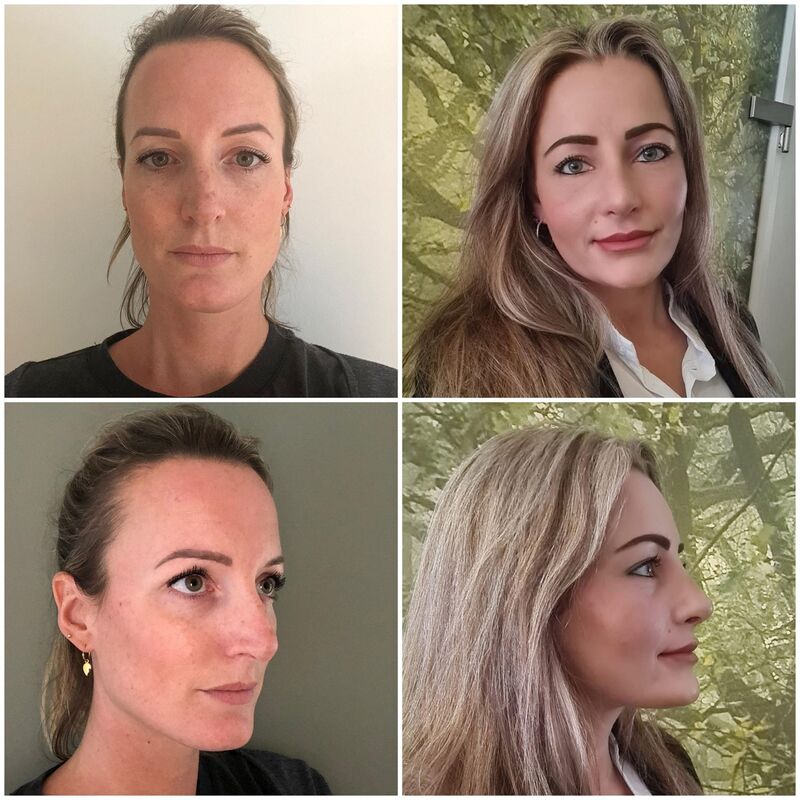 Esteworld bedankt voor mijn nieuwe neus!