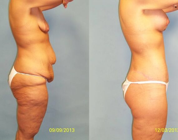 Mini-buikwandcorrectie Istanbul