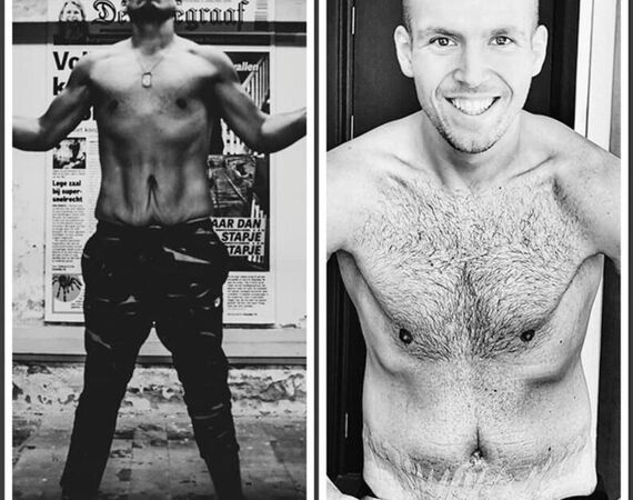 Mini-buikwandcorrectie Istanbul