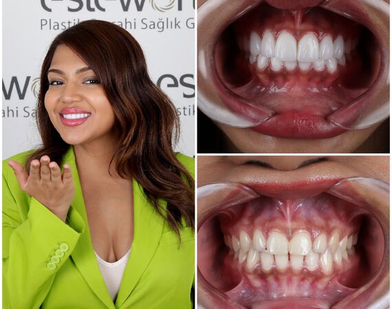 Hollywoodsmile Turkije