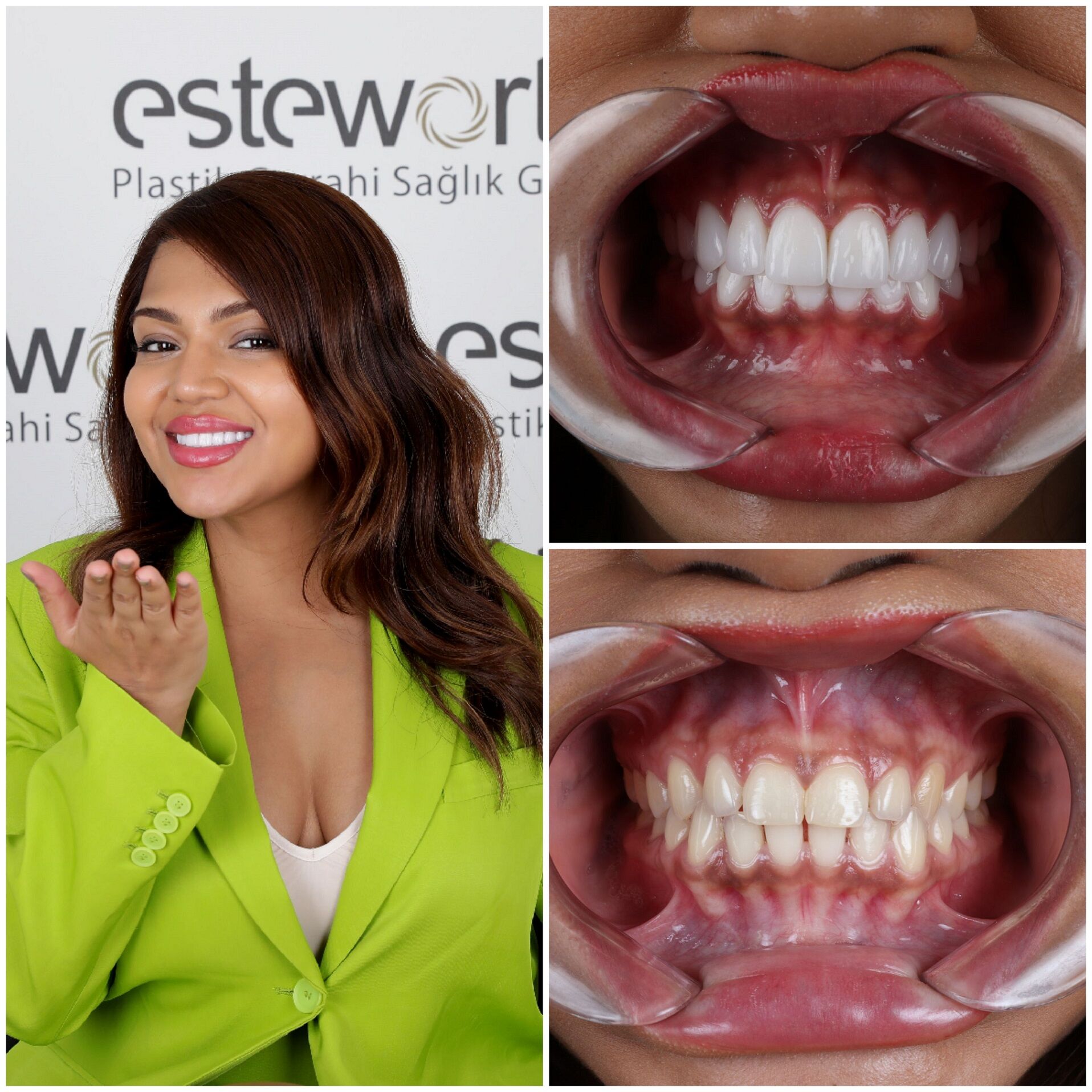 Hollywoodsmile Turkije