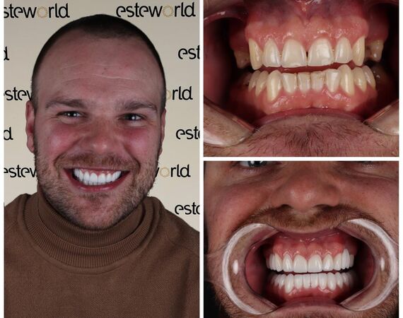 Hollywoodsmile Turkije