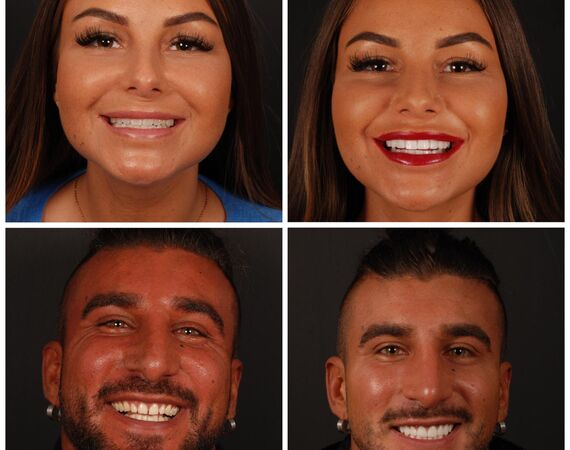 Hollywoodsmile Turkije