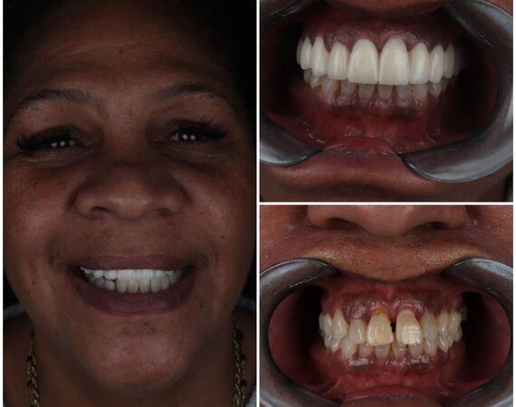 Hollywoodsmile Turkije