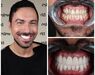 Hollywoodsmile Turkije